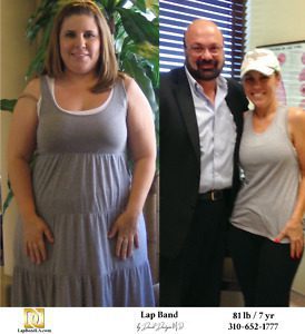 Elizabeth Didford Lap Band surgery Before & After by Dr. Davtyan at The Weight Loss Surgery Center Of Los Angeles