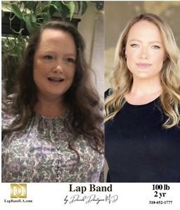 weight loss surgery before and after 