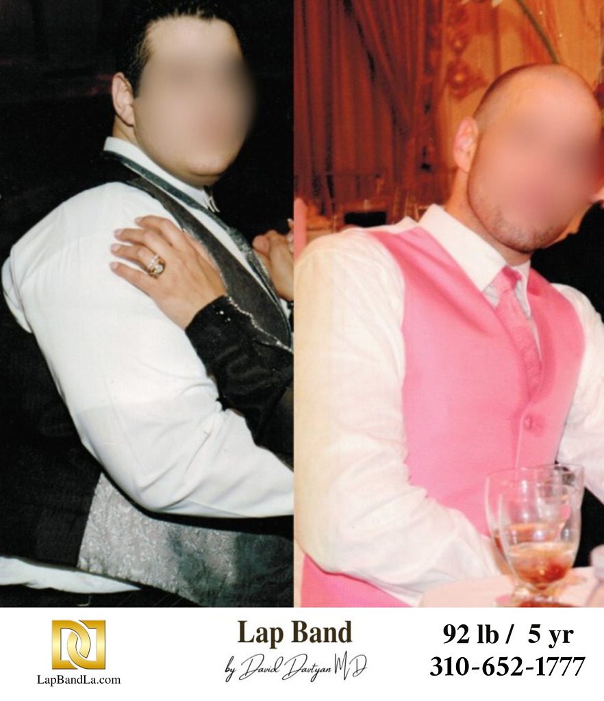 Before & After Lap Band Surgery | Patient Testimonials