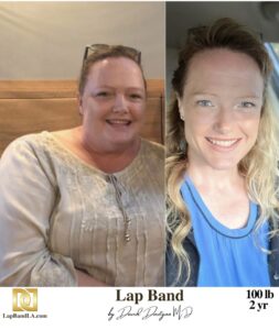 Fiona Lap Band surgery Before & After by Dr. Davtyan at The Weight Loss Surgery Center Of Los Angeles