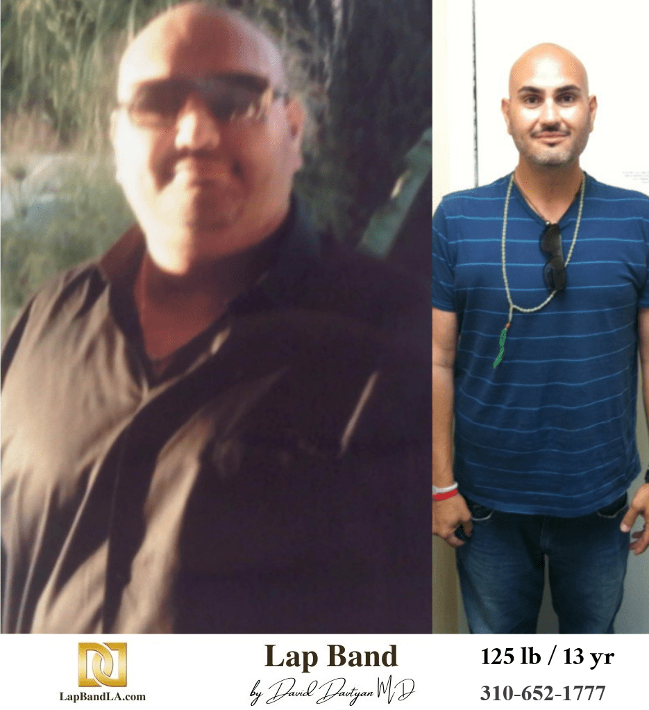Kashi T. Bariatric Surgery before and after los angeles