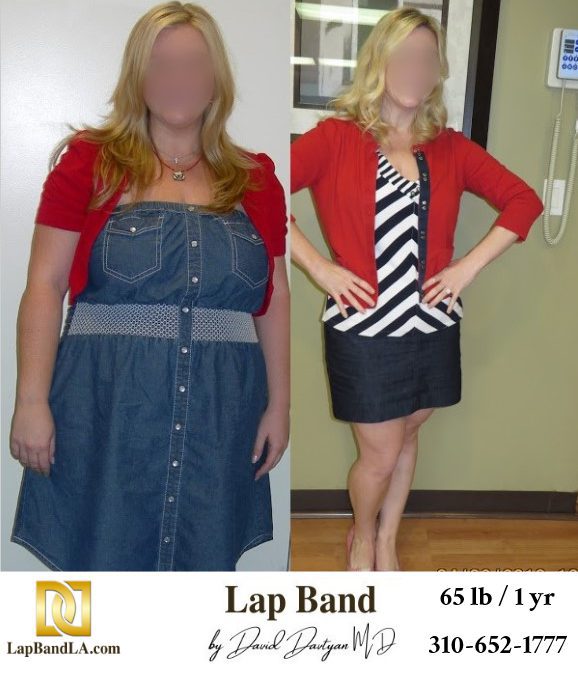 L.H. Bariatric Surgery before and after los angeles