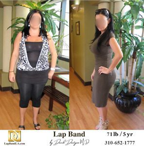 Weight Loss Surgery With Lapband before and after