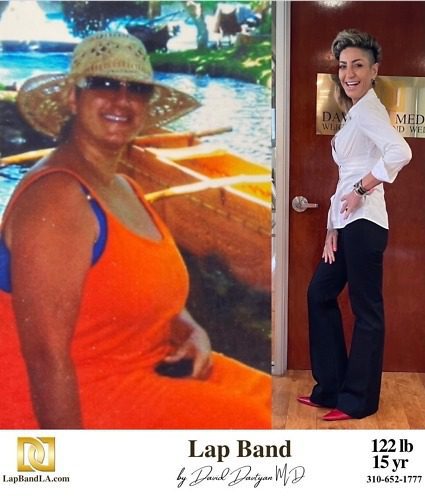 Lap Band Surgery Before And After By Dr Davtyan At Davtyan Medical Weight Loss And Wellness Lap 