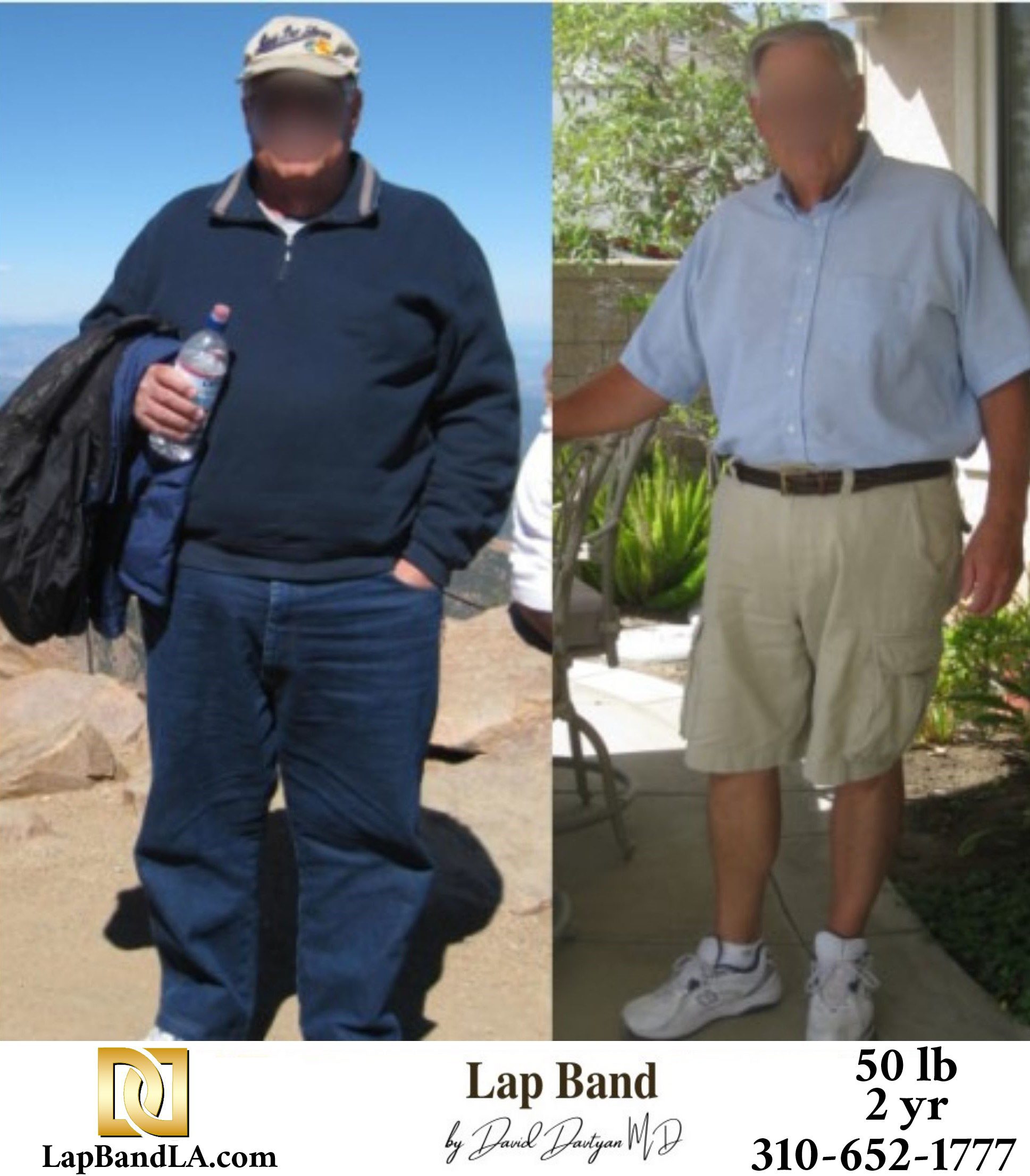 Lowell S. Bariatric Surgery before and after los angeles