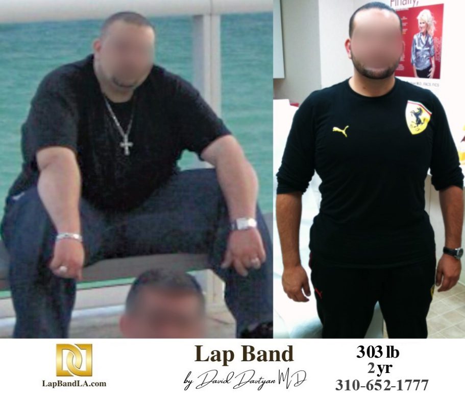 M.T. Bariatric Surgery before and after los angeles