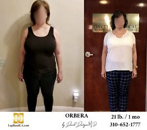 Orbera Balloon surgery Before & After by Dr. Davtyan at The Weight Loss Surgery Center Of Los Angeles