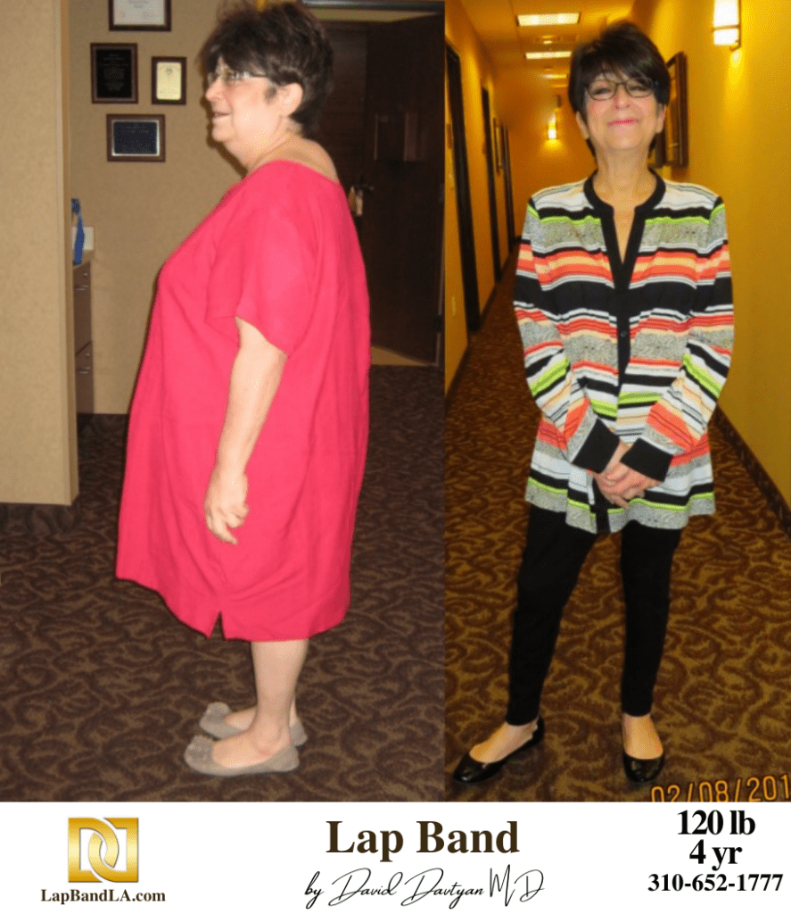 Before & After Lap Band Surgery Photo | Bariatric Surgery by Dr. Davtyan