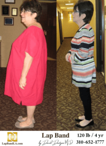 Before & After Lap Band Surgery | Patient Testimonials