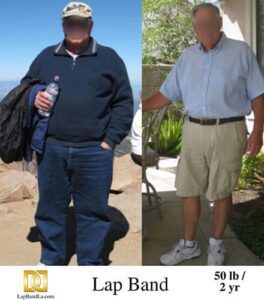 Lap Band surgery Before & After by Dr. Davtyan at The Weight Loss Surgery Center Of Los Angeles