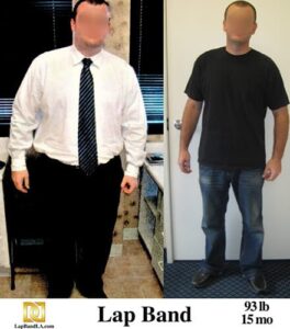 Bariatric Surgery Los Angeles before and after photo | Lap Band