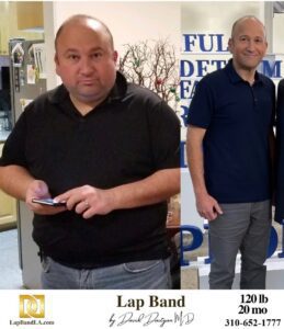 Before & After Lap Band Surgery | Patient Testimonials 