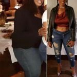 Before and after weight loss surgery Gastric Sleeve 1