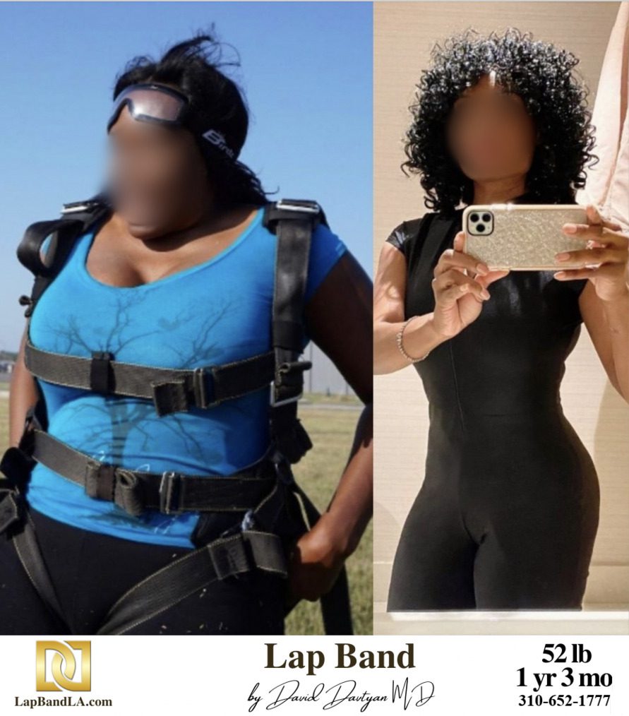 Lap Band Surgery Before And After Weight Loss Los Angeles Lap Band before and after 52 pound weight loss results