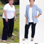 weight loss surgery los angeles before and after