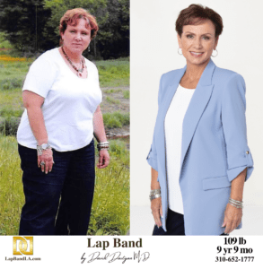 Deborah Lap Band surgery before and after by Dr. Davtyan at The Weight Loss Surgery Center Of Los Angeles