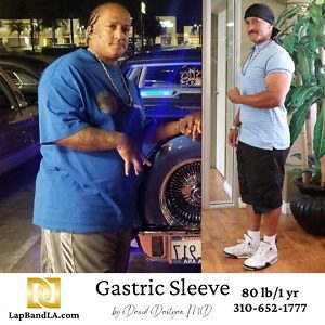 Gastric Sleeve Before and After