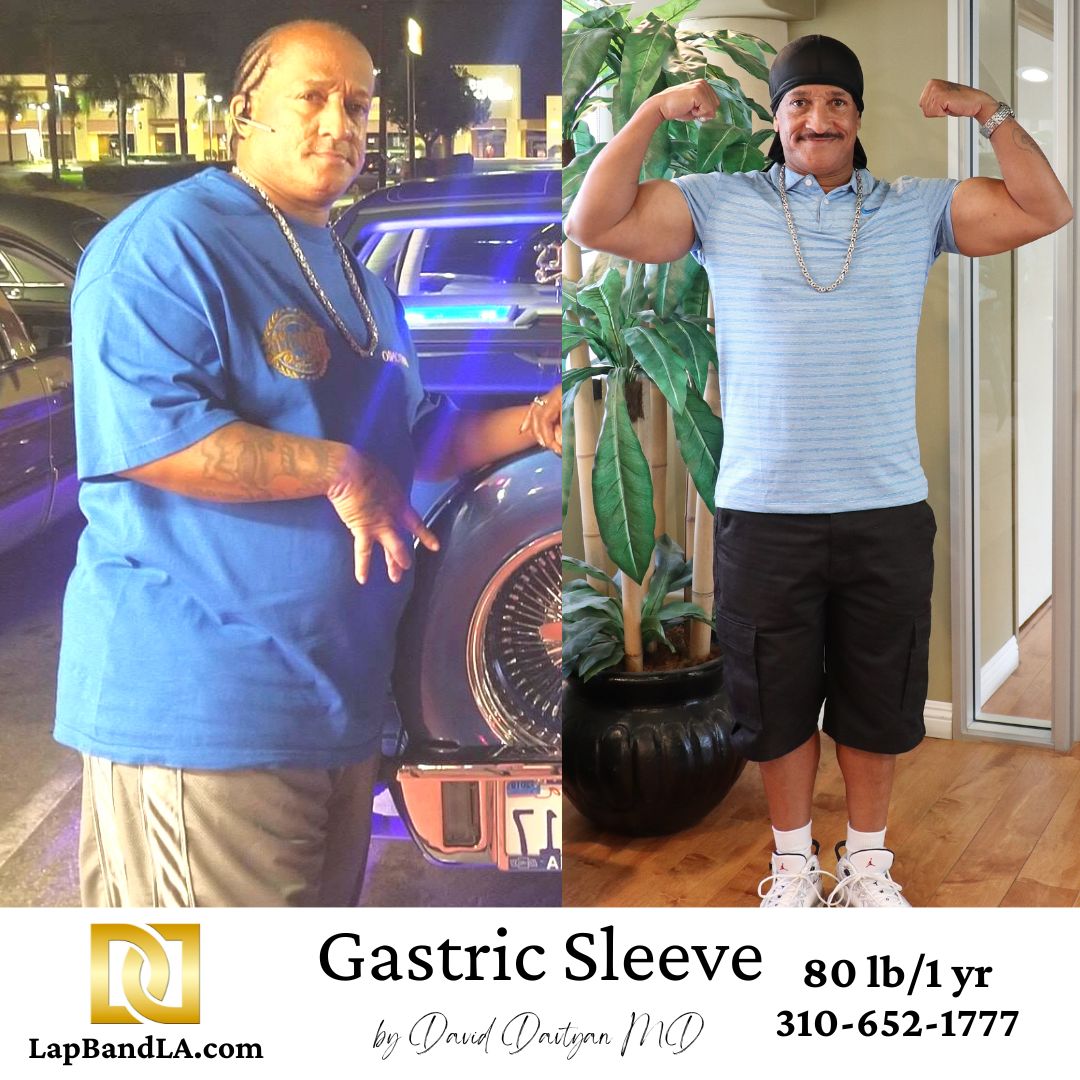 Gastric sleeve benefits-before and after of Antonio