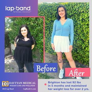 Lapband weight loss surgery before and after Brighton