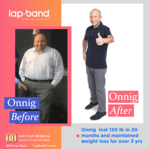 Lapband weight loss surgery before and after onnig