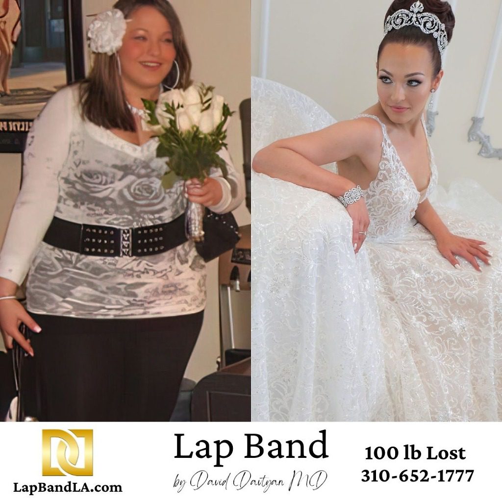 Lap Band benefits Before and After Wedding