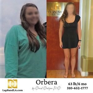 Orbera Gastric Balloon before and after comparison