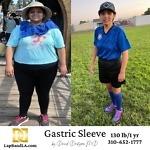 Gastric Sleeve Before and After comparison in Los Angeles