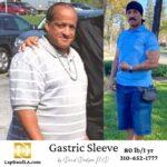 Gastric Sleeve Patient Before and After Comparison