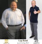 Lap band surgery la
