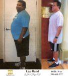 before and after bariatic surgery gastric sleeve