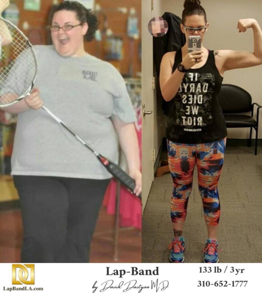 Lap Band Before After Bariatric Surgery Photo 4 min