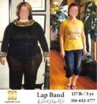 Lap Band Before After Bariatric Surgery