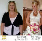 Lap band surgery patient before and after