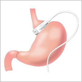 weight loss surgery rancho cucamonga
