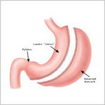 procedure gastric sleeve 1