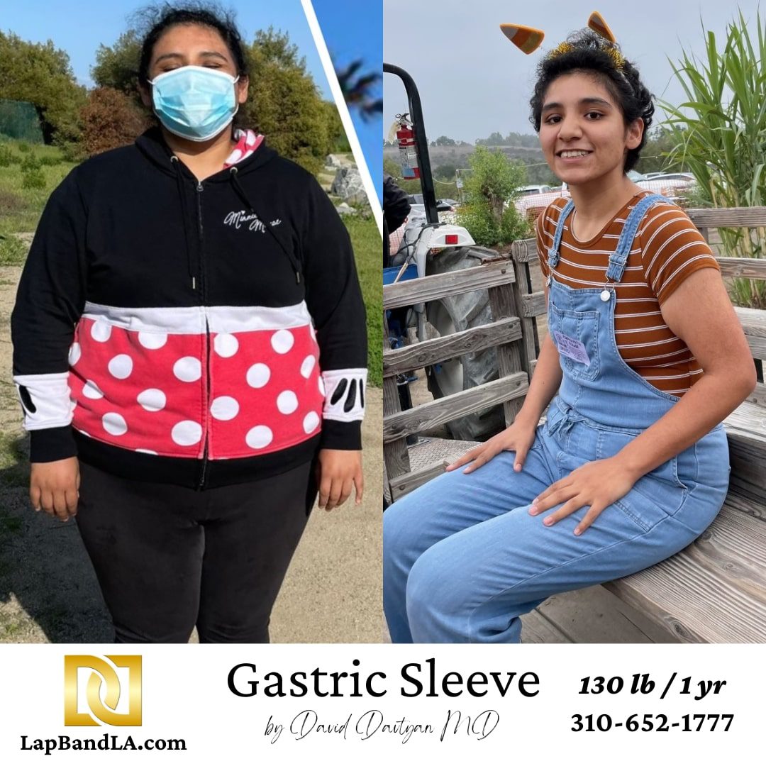 Gastric sleeve before and after weight loss transformation Female patient before and after gastric sleeve bariatric surgery at Lap Band LA