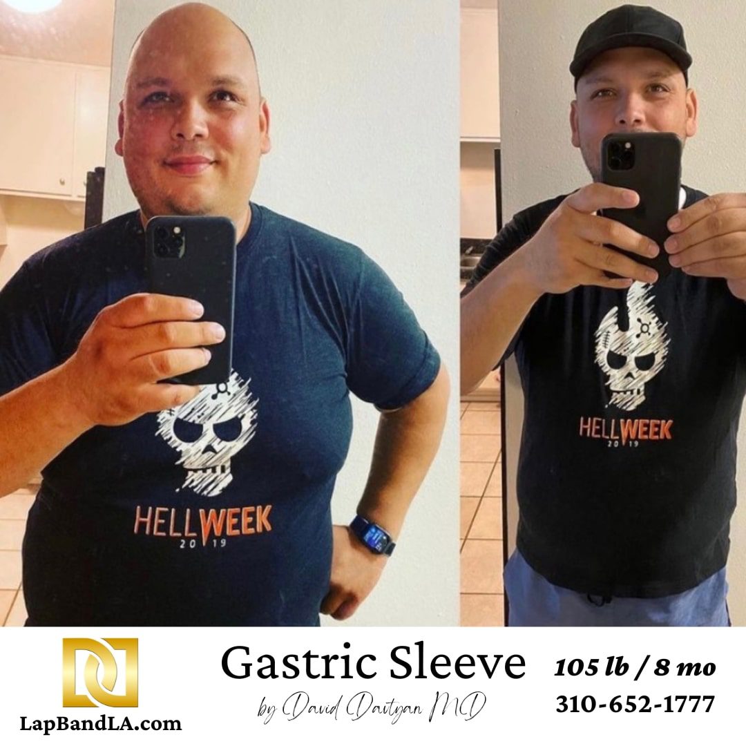 Gastric sleeve before and after 105 pound weight loss Male patient before and after gastric sleeve surgery showing 105 pound weight loss in eight months
