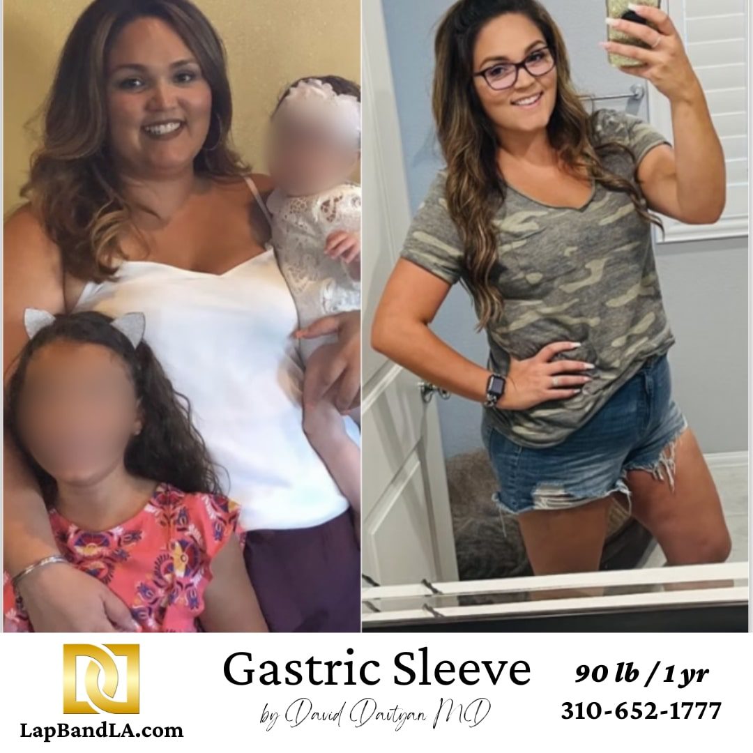 Gastric sleeve before and after weight loss surgery results Female patient before and after gastric sleeve bariatric surgery at Lap Band LA