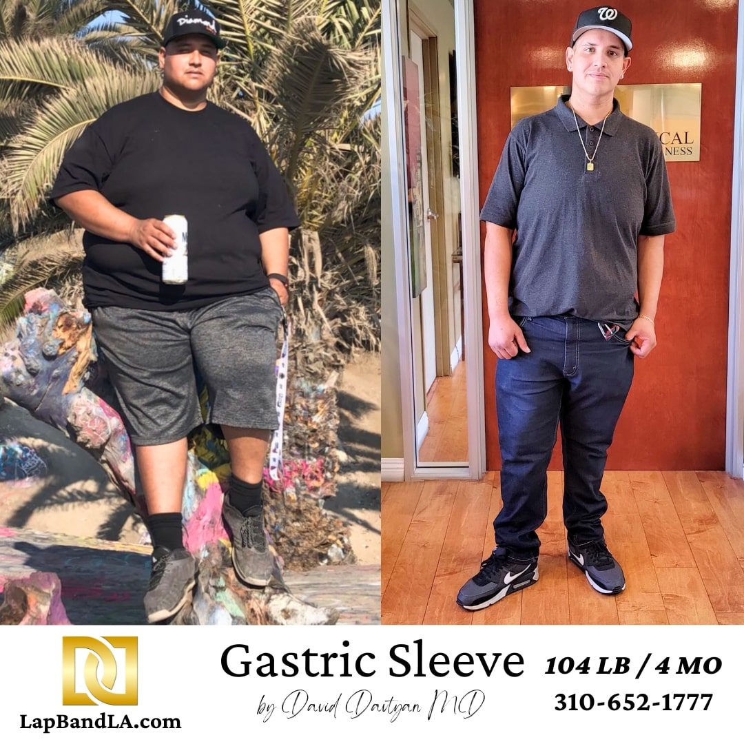 weight loss surgery before and after