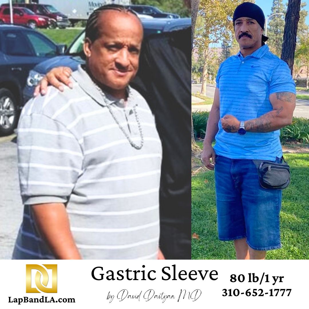 Male patient before and after gastric sleeve surgery showing 80 pound weight loss after one year