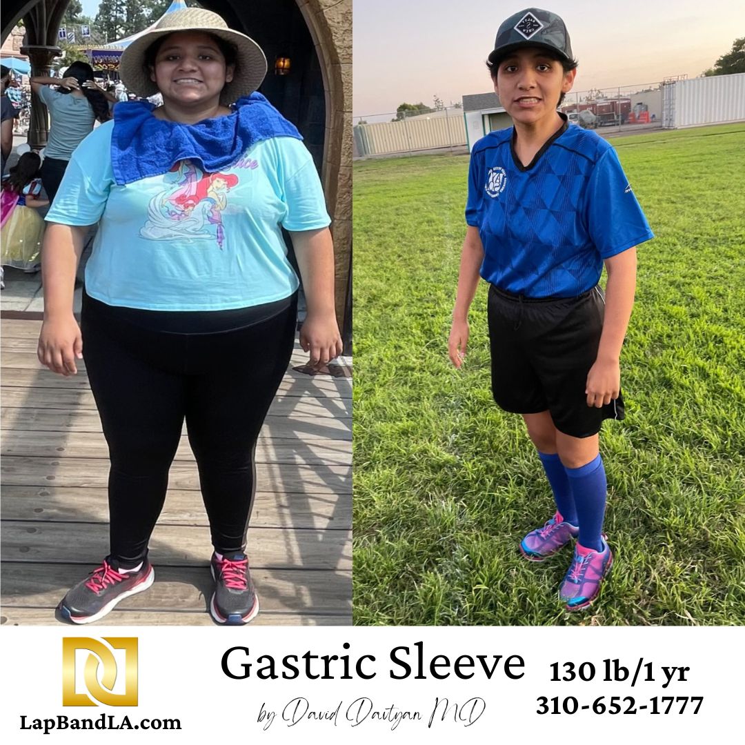 130 lb Weight Loss One Year After Gastric Sleeve Surgery in Los Angeles Patient before and after gastric sleeve surgery with 130 lb weight loss after one year