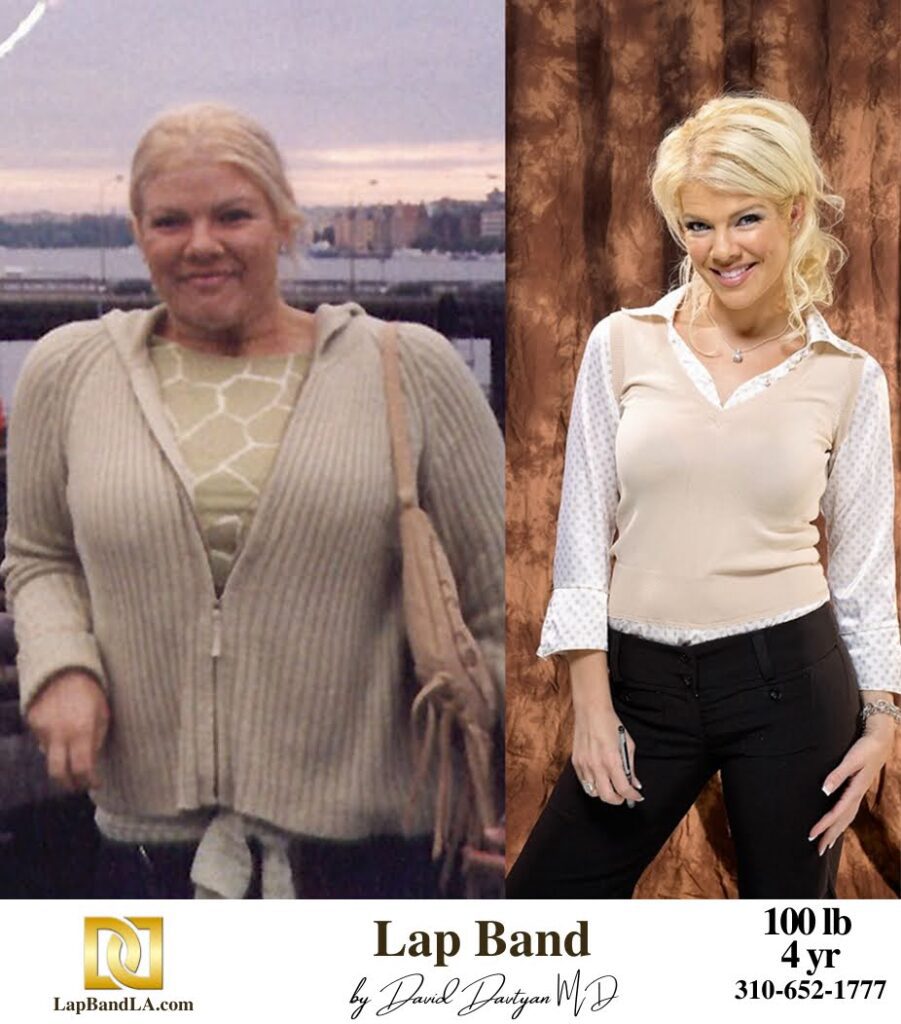 weight loss surgery los angeles