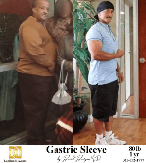 Gastric Sleeve Before & After