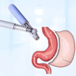 ozempic vs the gastric sleeve