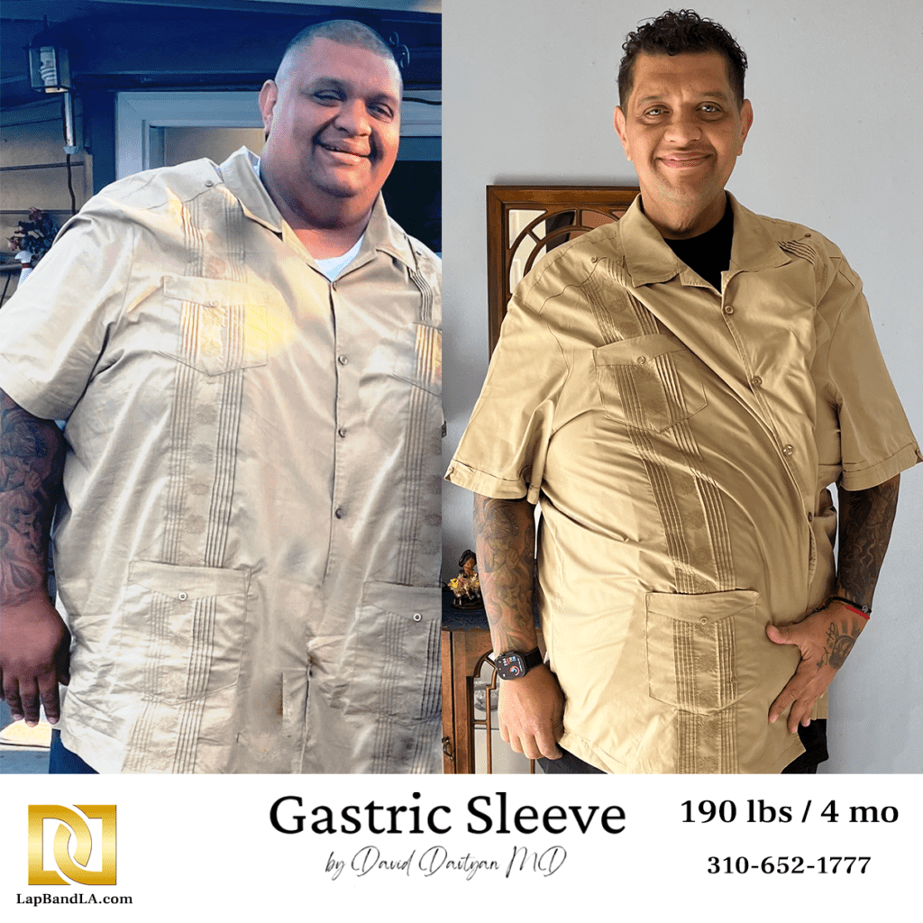 weight loss surgery before and after