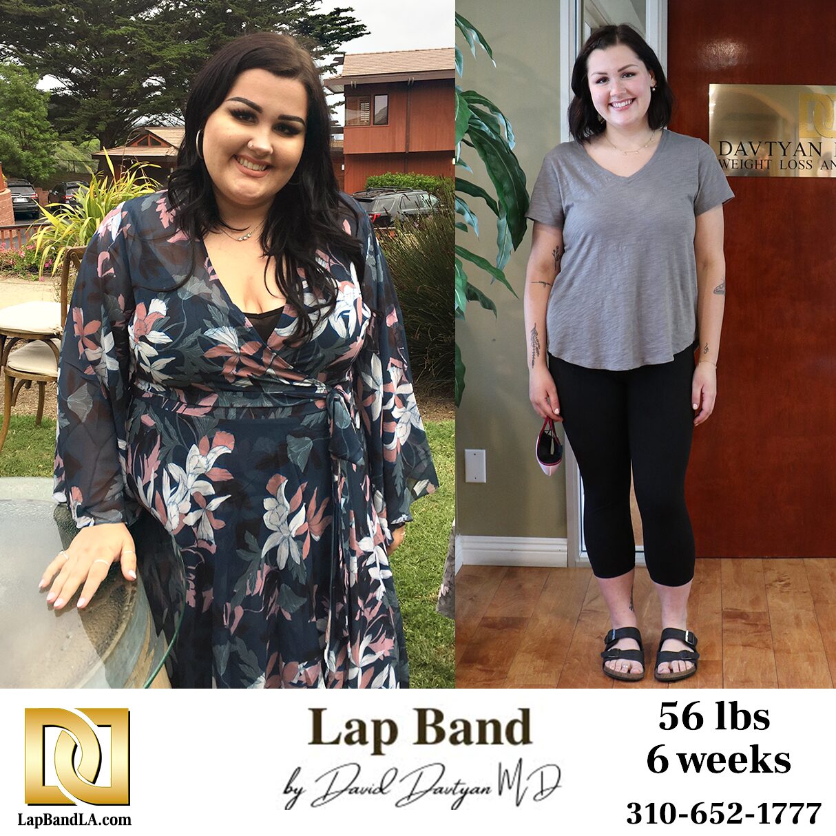 Brighton Before & 6 Weeks After Lap Band Davtyan Office weight loss surgery before and after
