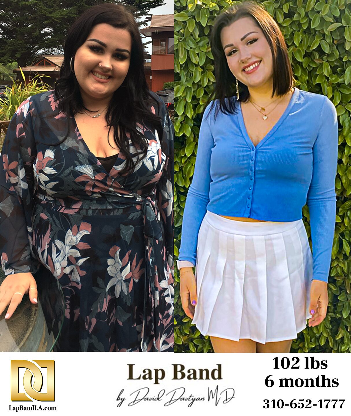 Brighton's before & after weight loss success: 102 lbs lost in just 6 months with the lap-band