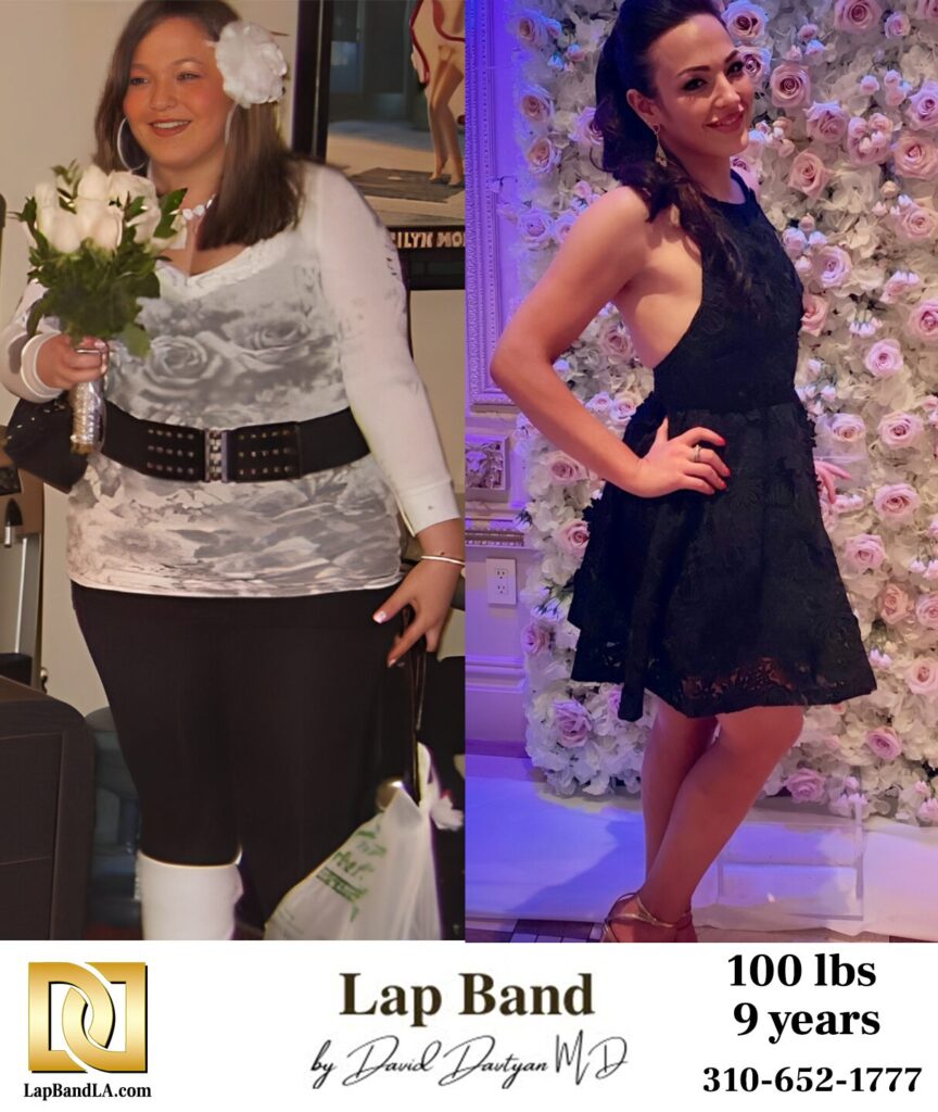 LapBandLA before & after: After losing 100 lbs with the Lap Band, Briyana started a family and found renewed happiness
