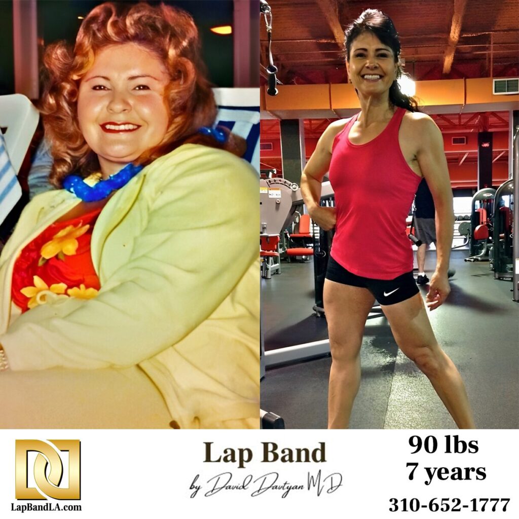 Female patient before and after Lap Band bariatric surgery transformation at Lap Band LA