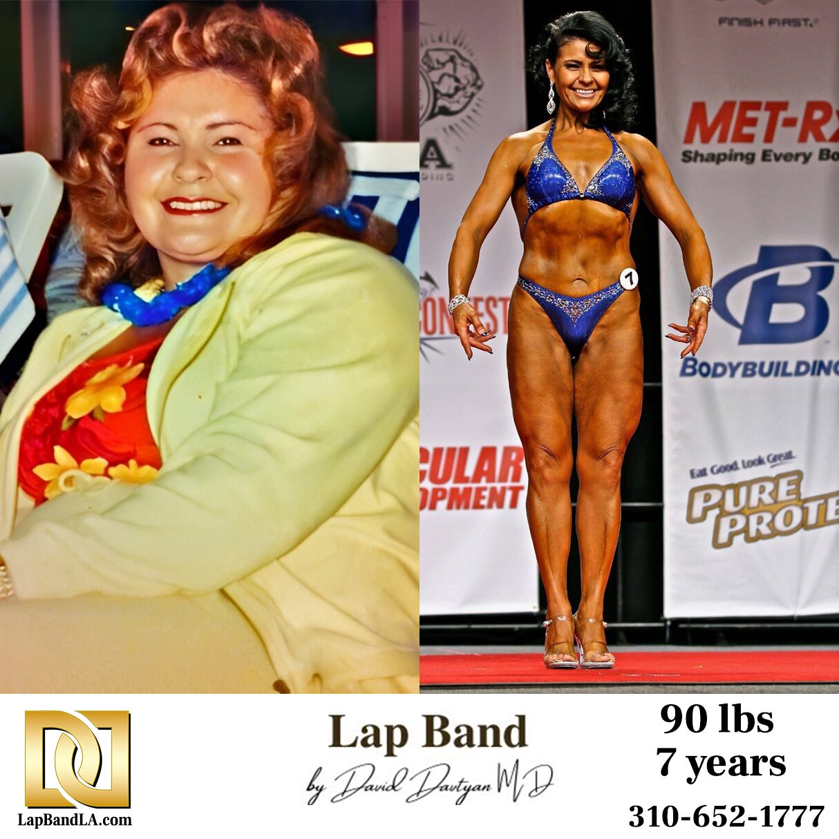 Lap band before and after weight loss transformation Female patient before and after lap band surgery showing long-term weight loss and fitness transformation